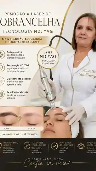 Remoção de sobrancelha a laser ND:YAG